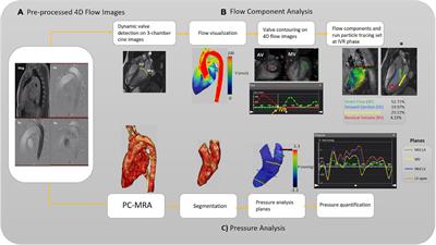 Intra-cardiac pressure drop and flow distribution of bicuspid aortic valve disease in preserved ejection fraction